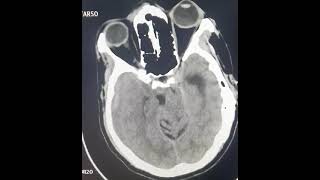 SDH  acuteonchronicsdh  ctscan craniotomy  urgent burr hole or craniotomy [upl. by Nerfe]