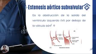 Estenosis aóticaecocardiografía [upl. by Acinyt907]