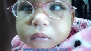 Nystagmus Blockage Syndrome  الرأرأة  العيون الراقصة [upl. by Arney]