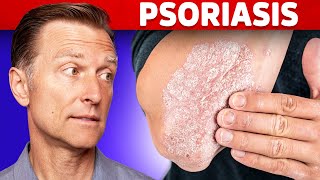 Psoriasis Treatment – The Best 3 Remedies for Psoriasis – DrBerg [upl. by Ocsisnarf399]