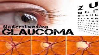 Understanding Glaucoma  Signs Symptoms Diagnosis amp Treatment [upl. by Orban171]