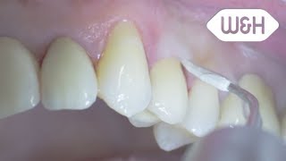 Tigon and periodontology tips 1P 1I English [upl. by Nhor455]