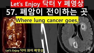 57폐암이 전이하는 곳 CT폐암전이사진lung cancer metastasis폐암사진전이암폐암진단뇌전이말기암사진닥터와이폐영상胸部X線PETCT검사 [upl. by Konstanze]