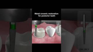 Metal Ceramic Preparation  Posterior Teeth ceramicpreparation ceramicdesign advanceddentistry [upl. by Ayra]