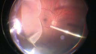 Vitrectomy for Giant Retinal Tear  Retinal Detachment  GRT  Dr Manish Nagpal [upl. by Gaal714]