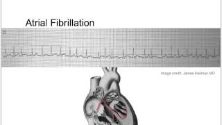 Tachycardia Basic Discussion [upl. by Labotsirc]