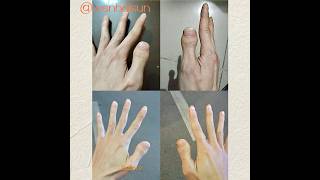 Brachydactyly type D toethumbs clubbed thumbs stubby thumbs thumbnail brachydactyly thumb [upl. by Ahsuoj]