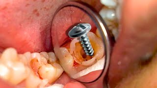 4K 😱 LOOK AT HIS TEETH ☠️ TREATMENT OF A REDUCED TOOTH WITH CARIES [upl. by Sitnerp]