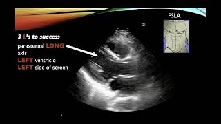 Basic Cardiac Ultrasound Views and Pathology  Echocardiography [upl. by Rolyt616]