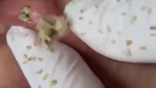 Big blackheads removal from nose [upl. by Marelda334]