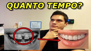 QUANTO TEMPO LEVA PARA O DENTE SE MOVER COM APARELHO  QUANTOS MILÃMETROS POR MÃŠS [upl. by Camellia]