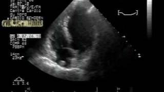 crista terminalis ridge mimicking right atrial mass [upl. by Yetnruoc]