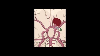 Neurosurgical clipping aneurysm shorts anatomy science [upl. by Eceinhoj]