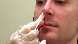 How To Treat Nosebleeds Epistaxis  Merck Manual Professional Version [upl. by Arotahs]