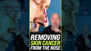 Removing Skin Cancer From the Nose 😱 shorts [upl. by Airtemak251]