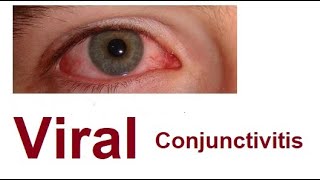 Viral Conjunctivitis [upl. by Flemming]