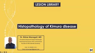 Histopathology of Kimura disease [upl. by Udele]