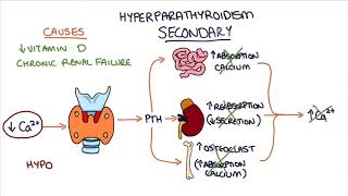 Understanding Hyperparathyroidism [upl. by Oicaroh505]