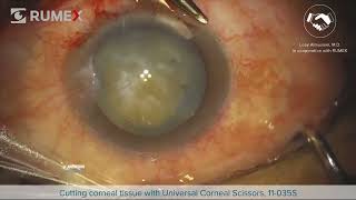 Surgery Live Cutting Corneal Tissue [upl. by Landri687]