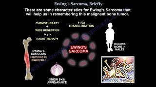 Ewings Sarcoma Briefly  Everything You Need To Know  Dr Nabil Ebraheim [upl. by Catlaina]