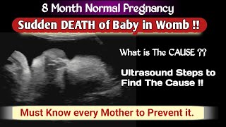 Sudden Baby Death in Womb  Ultrasound 8 month Pregnancy  what is Cause  Every Mother Should Know [upl. by Anuait]