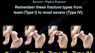 Femoral Head Fracture Review Pipken Fracture  Everything You Need To Know  Dr Nabil Ebraheim [upl. by Nosyaj]