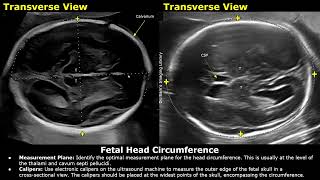 How To Measure Fetal Head Circumference HC On Ultrasound  Biometric Parameters  Obstetric USG [upl. by Oetsira625]