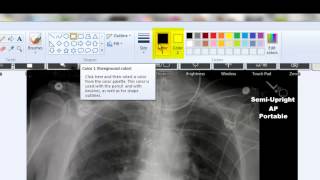 Removing Patient Info from Radiographs [upl. by Aneema]