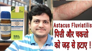 Homeopathic medicine Astacus Fluviatilis  Sign amp Symptoms  पित्ती और चकत्ते की दवा  Urticaria [upl. by Humbert]