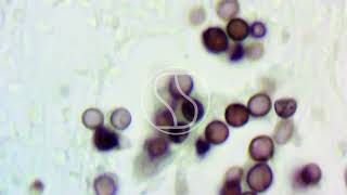 Lobomycosis under the microscope with Gomoris Methenamine Silver GMS stain [upl. by Moises57]