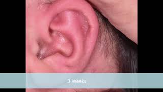 Lidding Ear  EarWell™ System  Dr Eric Payne  Houston TX [upl. by Cirde]