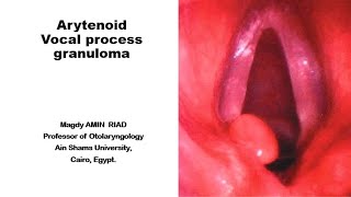 Arytenoid vocal process Granulomas [upl. by Solokin51]