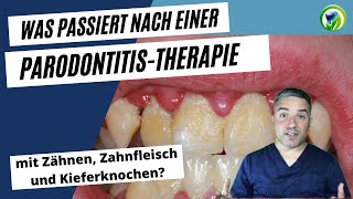 Was passiert mit Zähnen Zahnfleisch und Kieferknochen bei einer Parodontitistherapie [upl. by Oilerua776]