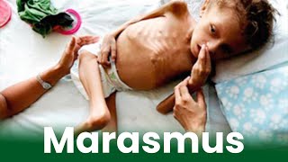 मरास्मस रोग किसकी कमी के कारण होता है Marasmus Disease Symptoms Causes amp Prevention amp Treatment [upl. by Uranie]