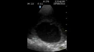 VSCAN Abdominal Aortic Aneurism Mural thrombus and snowstorm effect [upl. by Animahs431]