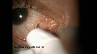 Treatment of Conjunctival Cyst Ablation using ALTP  Supplementary video ID 265032 [upl. by Lundin]