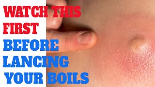 Lancing a boil  What You should do before lancing a boil  How to Lance  Pop  Boil Cyst [upl. by Lorenz]