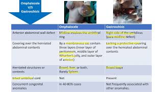 Omphalocele vs Gastroschisis  Spot Diagnosis  6  Pediatrics [upl. by Adelia316]