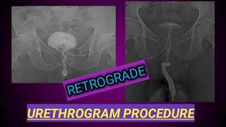 Retrograde Urethrogram Procedure  X ray Urethrogam  Urine Blockage [upl. by Ahseinad]