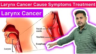 Larynx Cancer Cause Symptoms Diagnostic Evaluation Management  Laryngeal Cancer  Larynx Cancer [upl. by Lauzon]