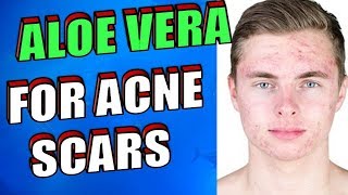 How To Use Aloe Vera OVERNIGHT To Treat Acne Scars Pimples amp Zits [upl. by Clemens350]