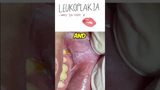 Oral Leukoplakia  Dentogenesis [upl. by Asseralc]