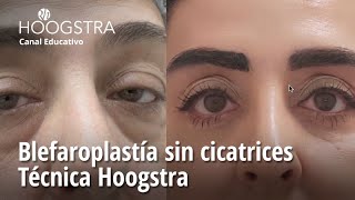 Blefaroplastía sin cicatrices  Técnica Hoogstra  23236 [upl. by Webb]