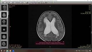 Pilocytic astrocytoma [upl. by Guendolen116]