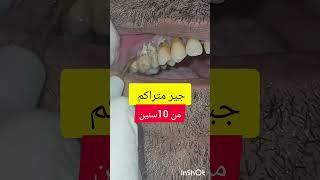 ازالة وتنظيف جير و تقليح الاسنان dentist stitch اكسبلور stitchlover ترند [upl. by Jacques]