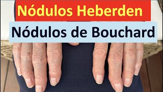 Nódulos de Heberden y Bouchard [upl. by Harday469]