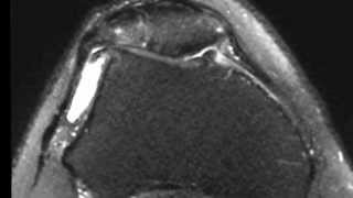 Corpsetrangers et arthrose fémoropatellaire genou et IRM [upl. by Yemrots]