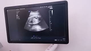 hydronephrosis with hydroureter of Rt kidney [upl. by Faxon548]