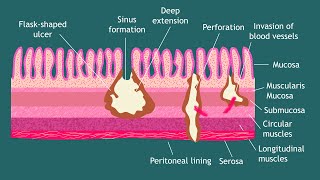 Pathogenesis of Entamoeba histolytica Notes  Parasitology  Basic Science Series [upl. by Dodie]