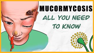 Mucormycosis microbiology types signs amp symptoms diagnosis treatment [upl. by Euqinoj501]